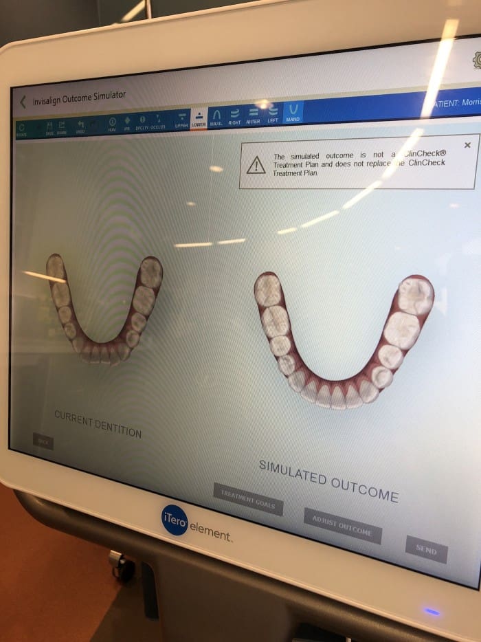 Invisalign with SmileRefresh 1st appointment